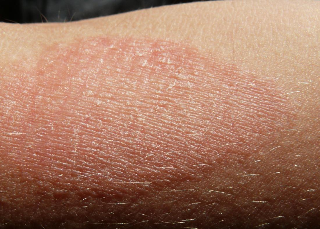 eczema1