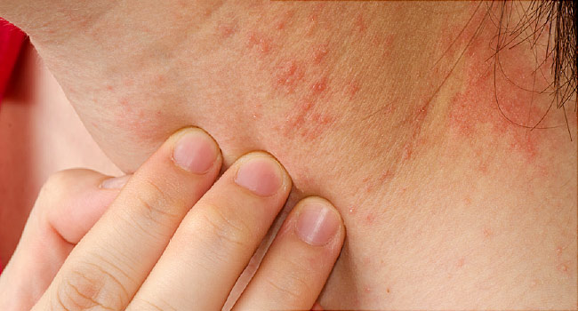 eczema2