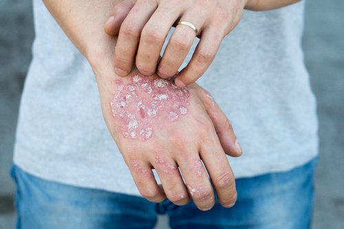 eczema3