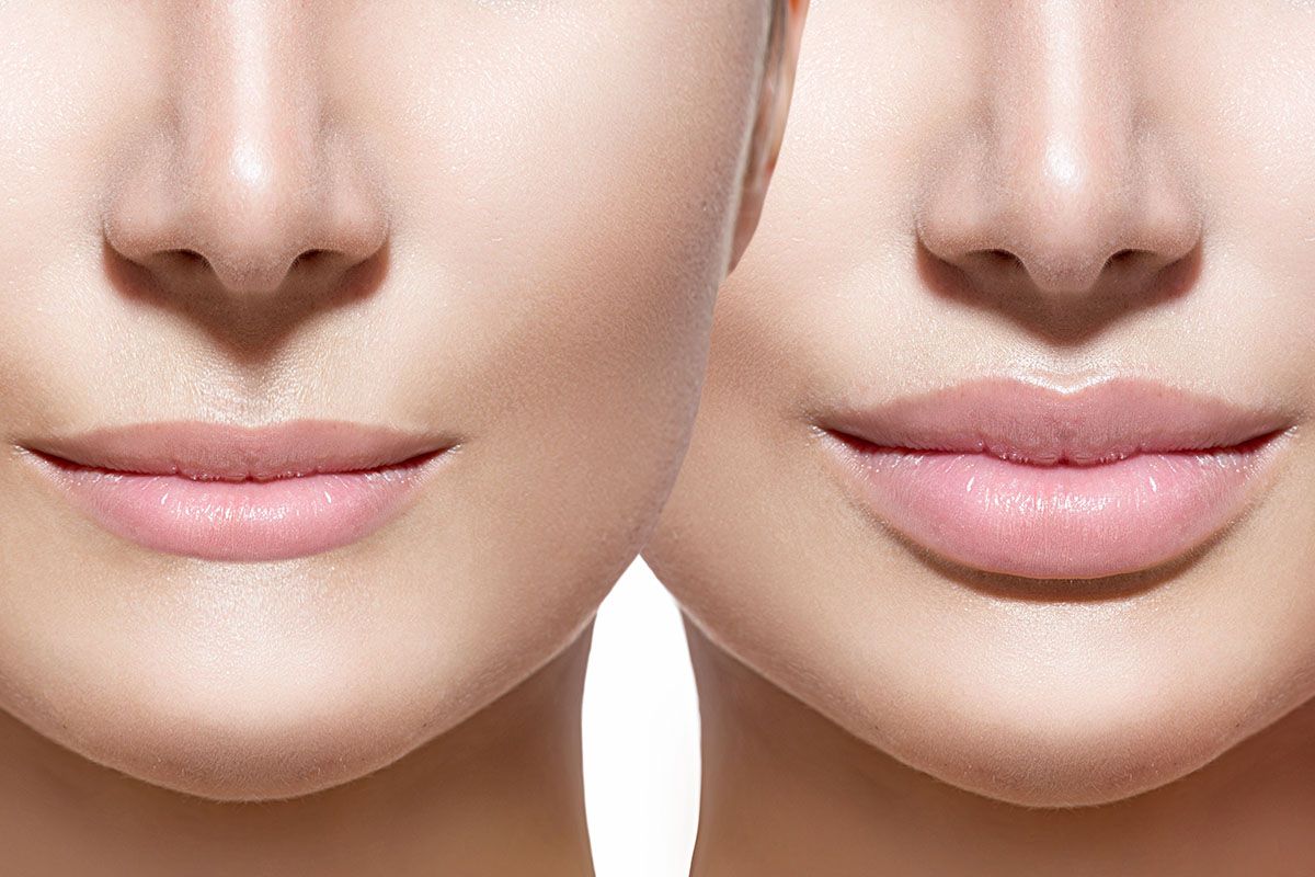 lip enlargement