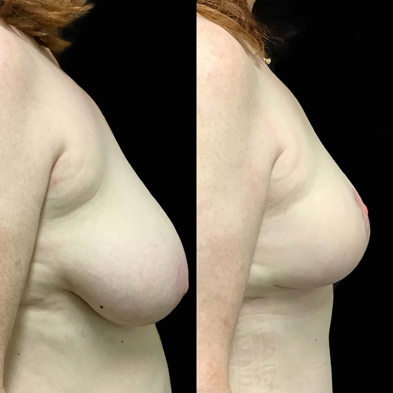 Breast Reduction Treatment 1