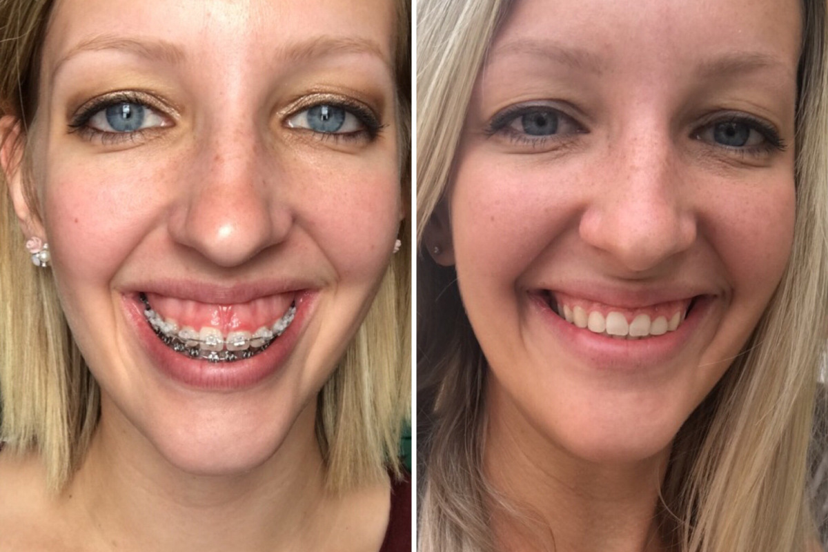 Gummy smile correction1