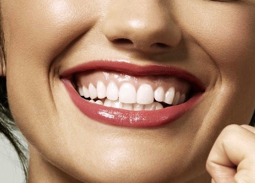 Gummy smile correction3
