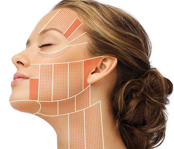 HiFU treatment2