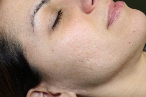 PICO skin treatment1