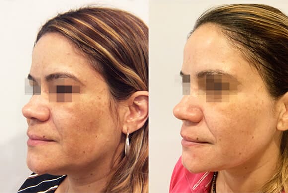 PICO skin treatment2