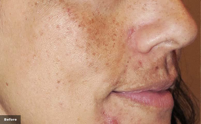 PICO skin treatment3