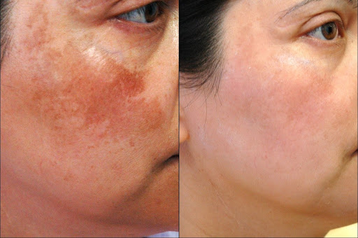 Pigmentation Treatment1