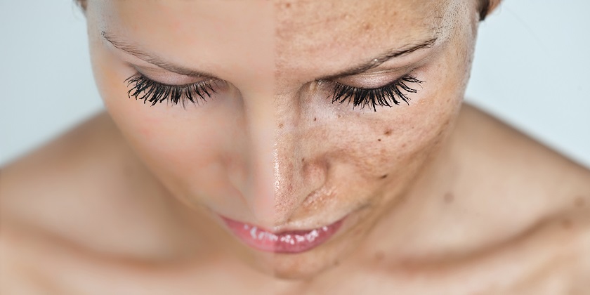 Pigmentation Treatment2