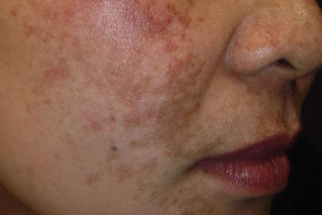 Pigmentation Treatment3