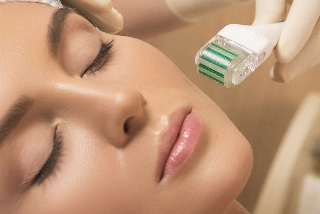 microneedling for acne scars
