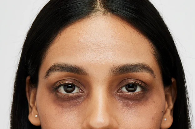 Dark Circles Treatment