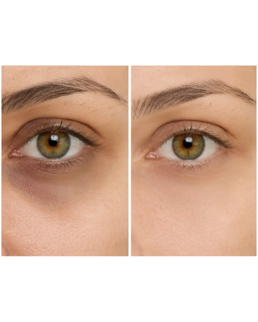 Dark Circles Treatment Islamabad