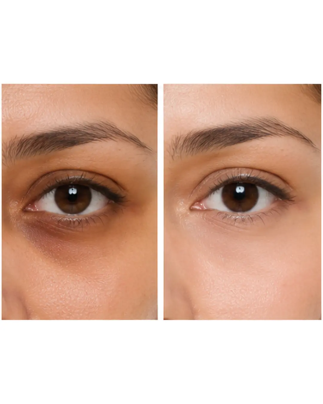 Dark Circles Treatment in Islamabad