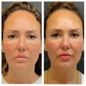 Non-Surgical Facelift Treatments 12 non surgical face lift in islamabad by dr shumaila khan in Dermalase Clinic F10 Islamabad