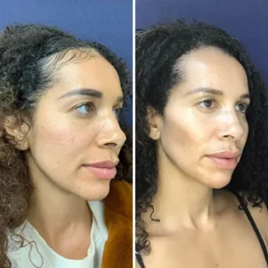 non surgical face lift in islamabad by dr shumaila khan in Dermalase Clinic F10 Islamabad