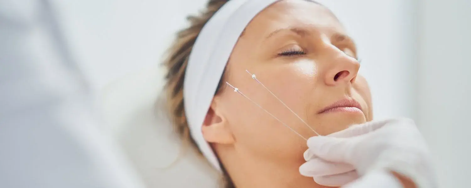 Thread Lifting Treatment in Dermalase Clinic Islamabad