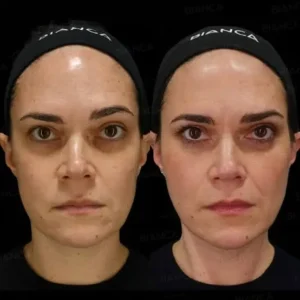 Before and after results of Thread lift treatment in Islamabad by Dr Shumaila Khan