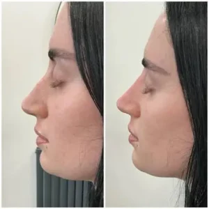 Before and After results of non surgical nose job in islamabad by Dr Shumaila Khan in Islamabad.