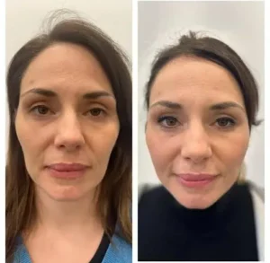 Before and after results of Thread lift treatment in Islamabad by Dr Shumaila Khan