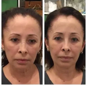 Before and after results of Thread lift treatment in Islamabad by Dr Shumaila Khan
