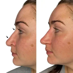 Before and After results of non surgical nose job in islamabad by Dr Shumaila Khan in Islamabad.