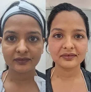 Before and after results of Thread lift treatment in Islamabad by Dr Shumaila Khan